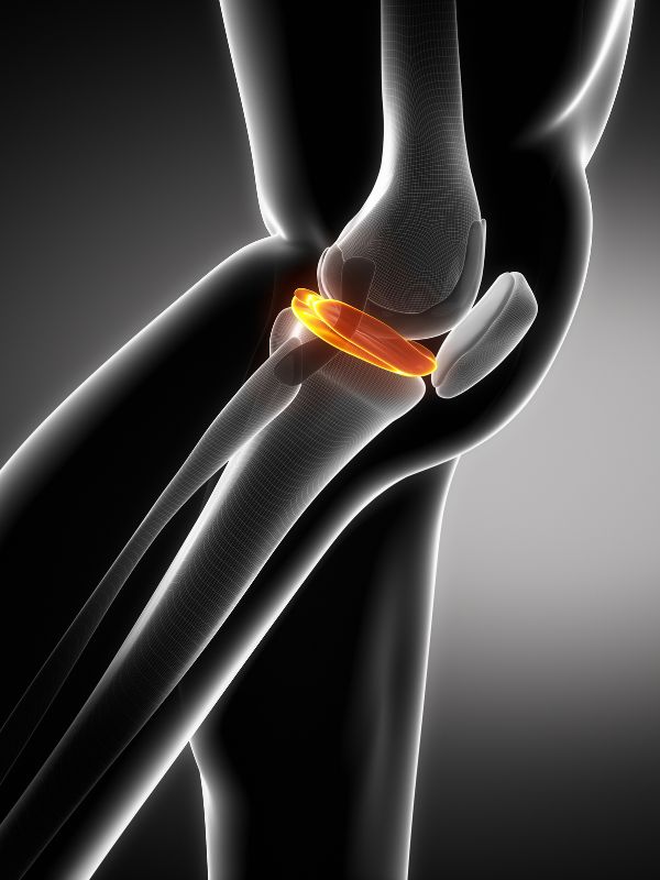 Knestøtte ved meniskskade